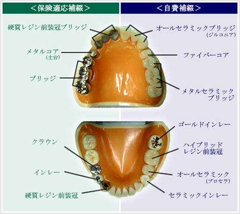 クラウン　ブリッジ　被せ物　技工　歯科