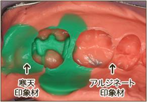 とれた歯型。この歯型に石膏を流します。