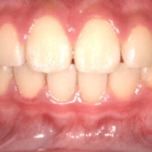 前歯のすきまと出っ歯の矯正事例