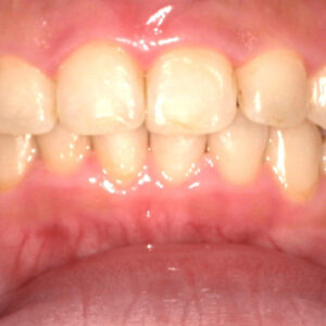 前歯のガタガタの矯正事例